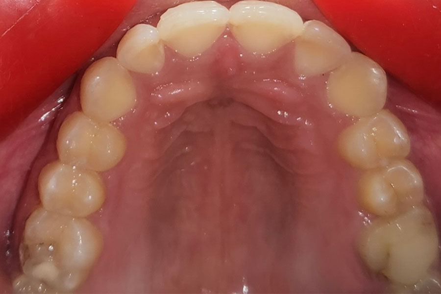 Clear Aligners