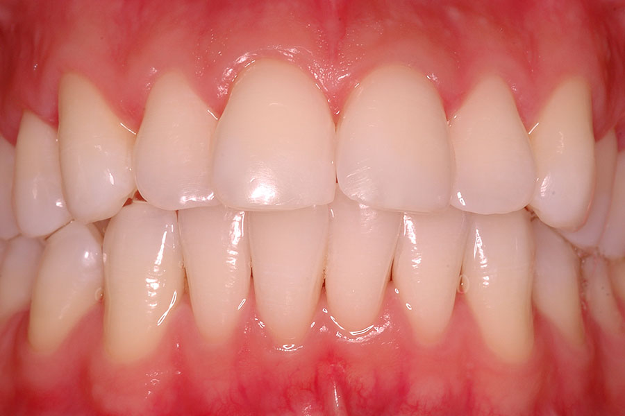 Teeth Bleaching