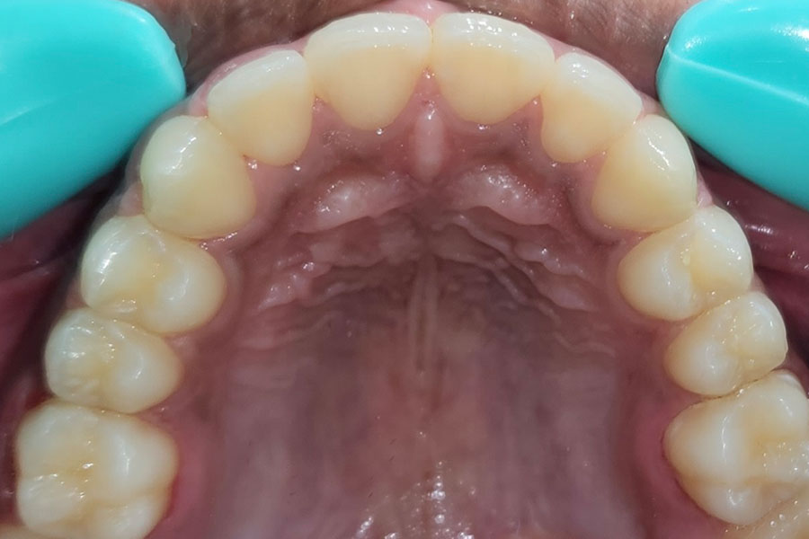 Braces for a Beautiful smile