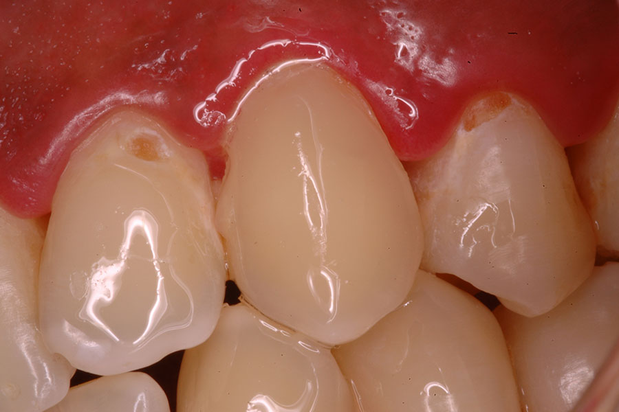 Dental Fillings