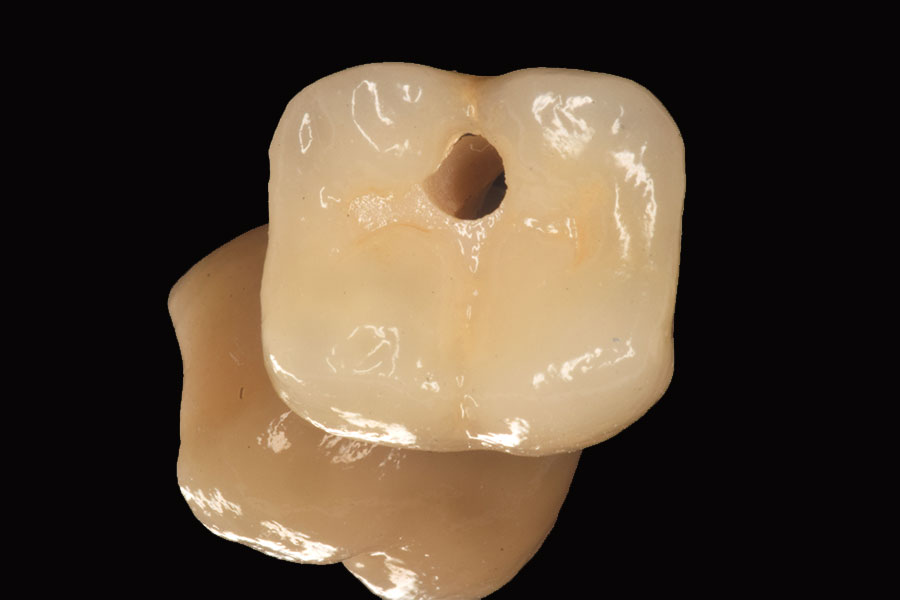 Dental Implants