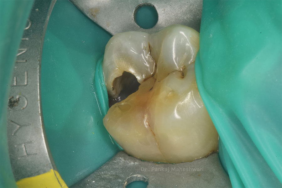 Root Canal Treatment